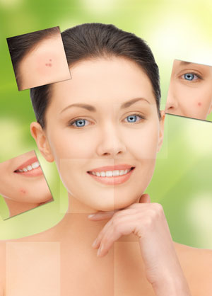 acne female face