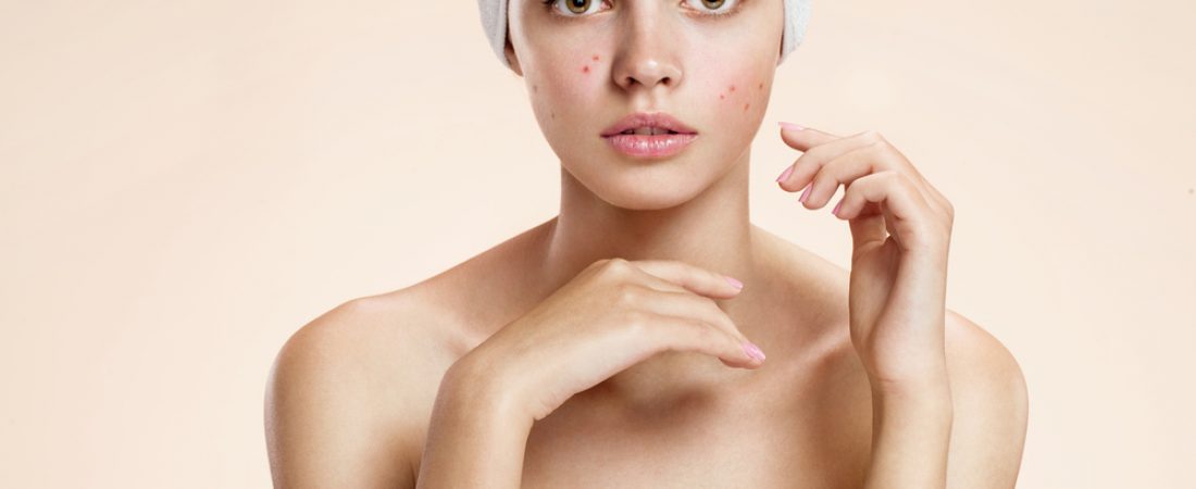 Everything You Need to Know About Adult Acne