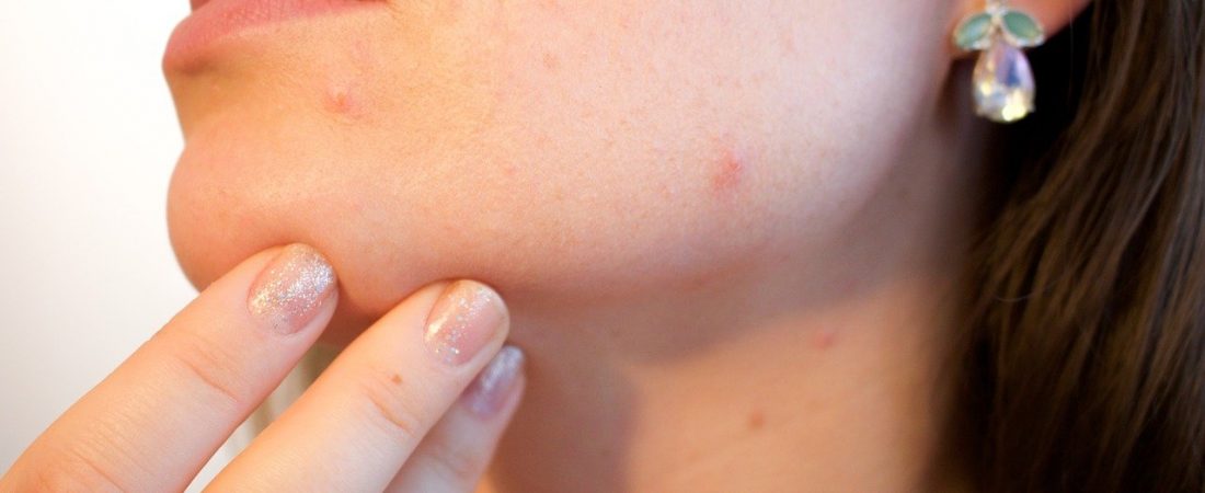 Adult Acne Solutions